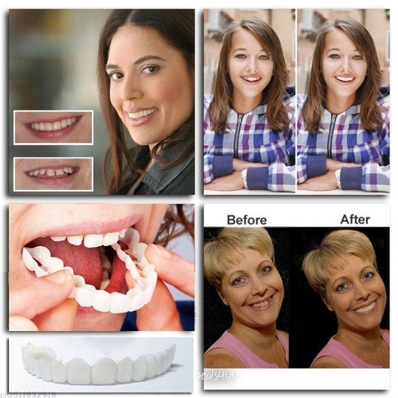 SnapDent™ Snap-On Dentures